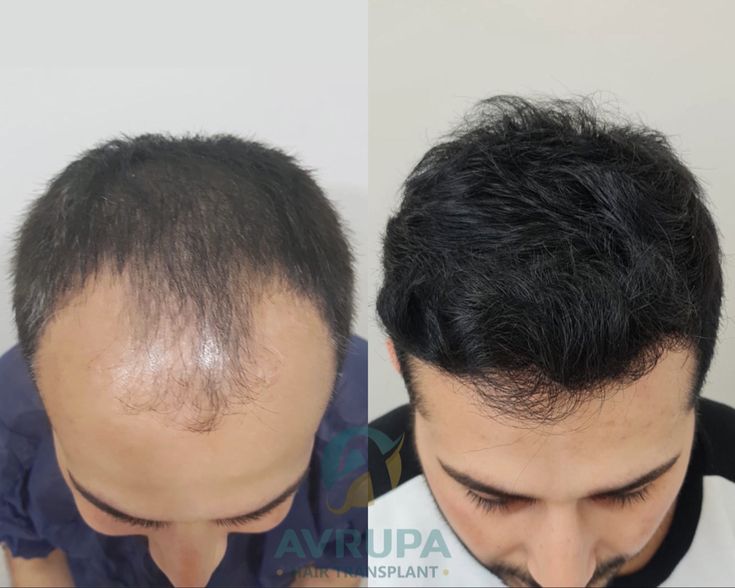 Hair Transformation by FUE
